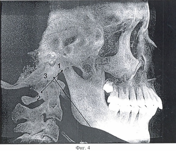 Способ нахождения анатомической плоскости, являющейся параллельной плоскости окклюзии (патент 2471452)