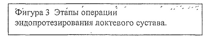 Способ лечения тяжелых внутрисуставных переломов локтевого сустава (патент 2463980)