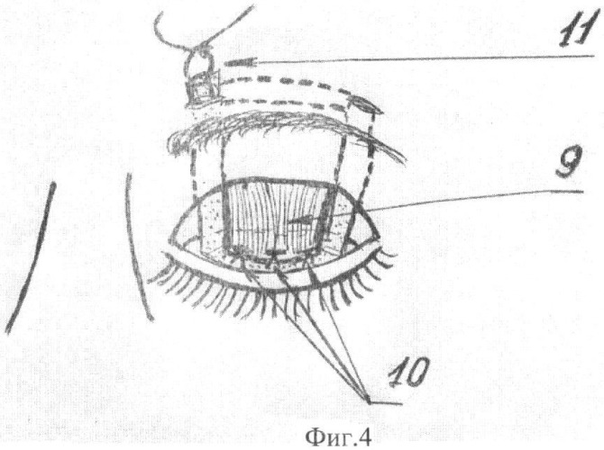 Способ хирургического лечения птоза верхнего века тяжелой степени (патент 2440073)