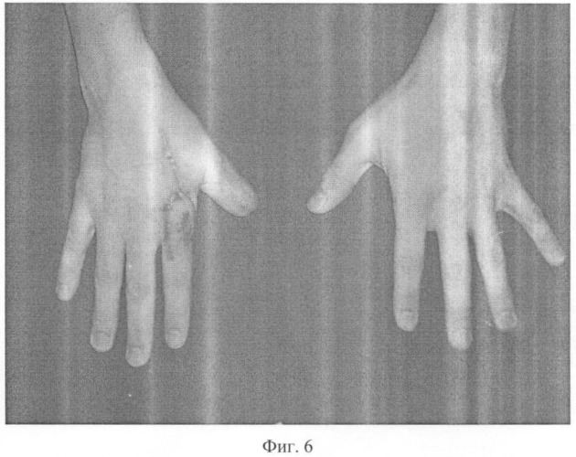 Способ кожной пластики при отрыве первого пальца кисти (патент 2336839)