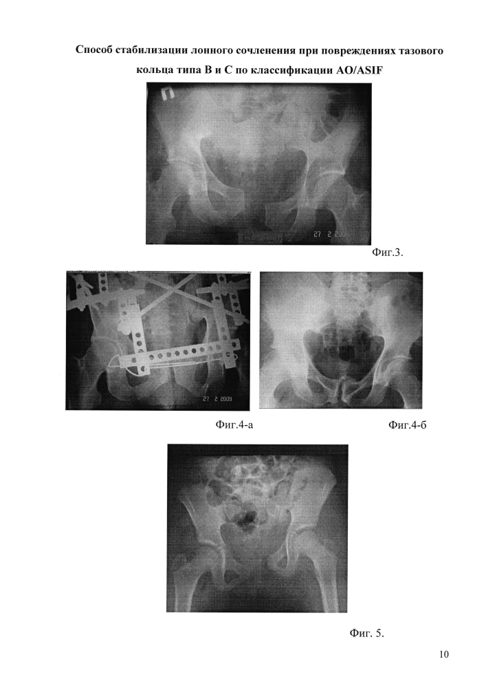 Способ стабилизации лонного сочленения при повреждениях тазового кольца типа в и с по классификации ao/asif (патент 2600490)