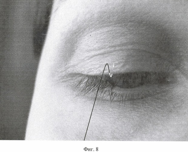 Способ имплантации ресниц (его варианты) (патент 2446751)