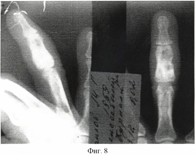 Способ лечения энхондром фаланг и пястных костей кисти (патент 2489107)