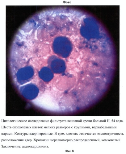 Способ определения раковых клеток в периферической венозной крови у больных с подозрением на злокачественные новообразования (патент 2425385)