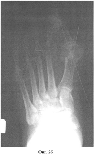 Способ лечения деформации первого пальца стопы (патент 2423084)