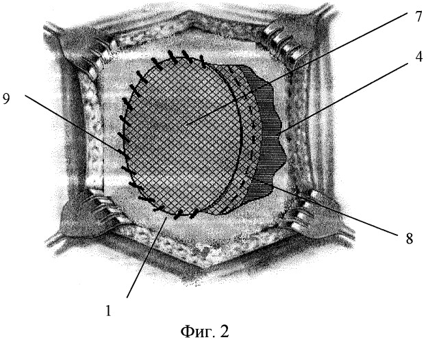 Способ пластики послеоперационных вентральных грыж (патент 2270614)