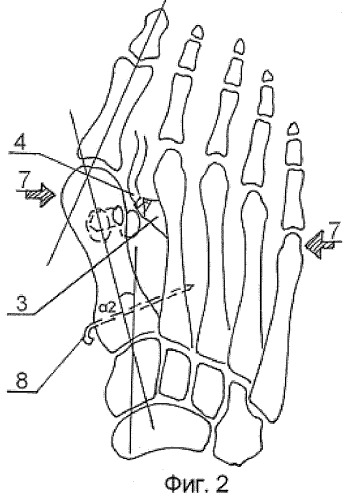 Способ лечения выраженных стадий поперечной распластанности стопы (патент 2315578)