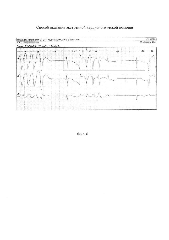 Способ оказания экстренной кардиологической помощи (патент 2644303)