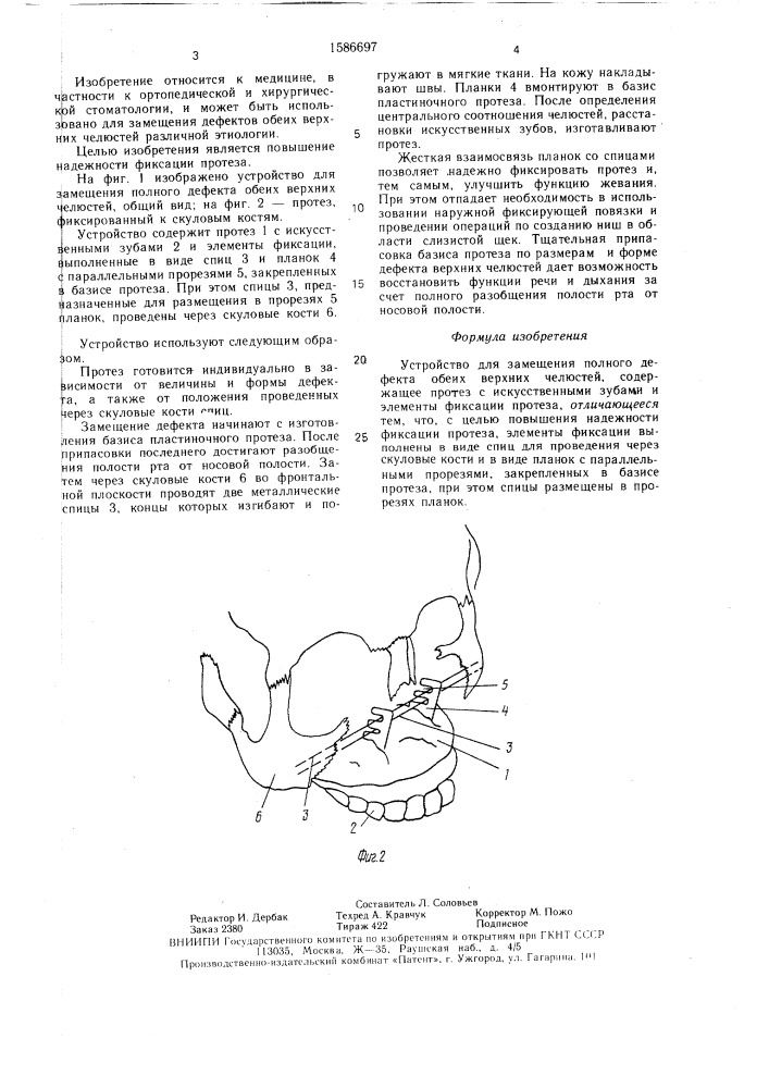 Устройство для замещения полного дефекта обеих верхних челюстей (патент 1586697)
