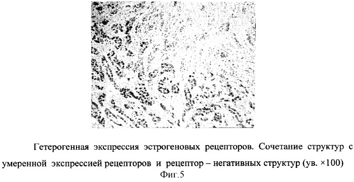 Способ прогнозирования течения заболевания раком молочной железы (патент 2300111)