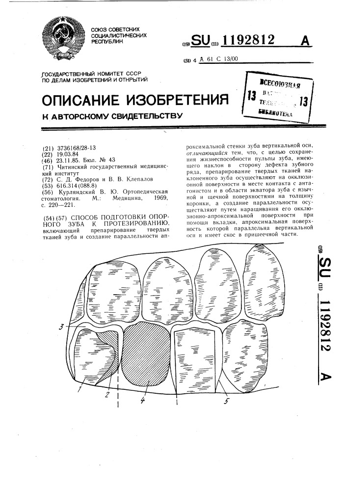 Способ подготовки опорного зуба к протезированию (патент 1192812)