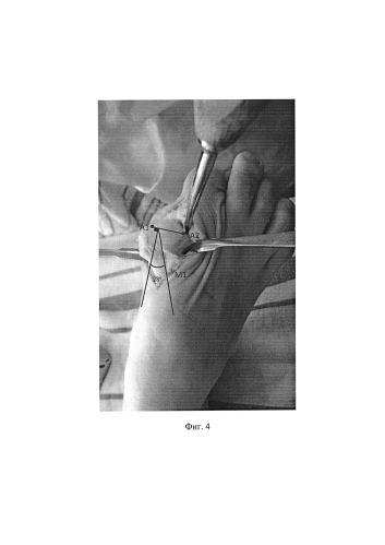 Способ оперативного лечения вальгусного отклонения первого пальца стопы (патент 2592604)