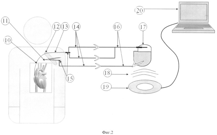 Переходник к деимплантированному кардиостимулятору (патент 2405590)
