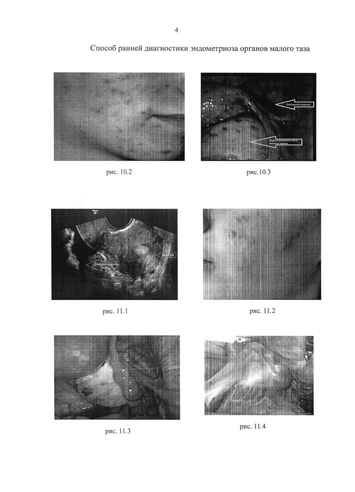 Способ ранней диагностики эндометриоза органов малого таза (патент 2616995)