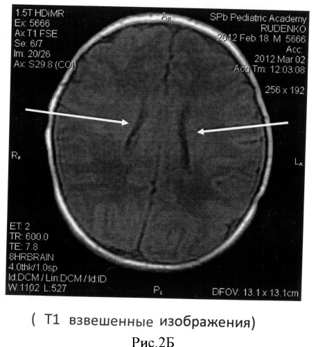 Способ определения зрелости церебральных структур у недоношенных новорожденных (патент 2491888)