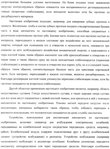 Имплантаты для создания соединений с тканями, в частности со скелетом, а также устройство и способ имплантации (патент 2314768)
