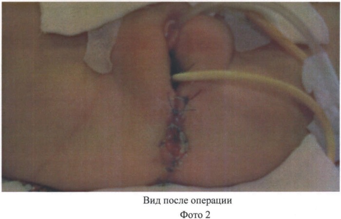 Способ оперативного лечения персистирующей клоаки у девочек (патент 2482802)