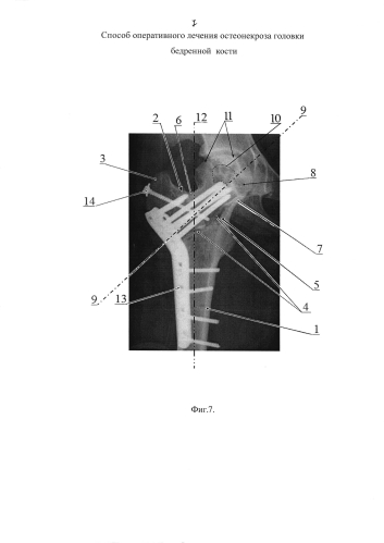 Способ оперативного лечения остеонекроза головки бедренной кости (патент 2578833)
