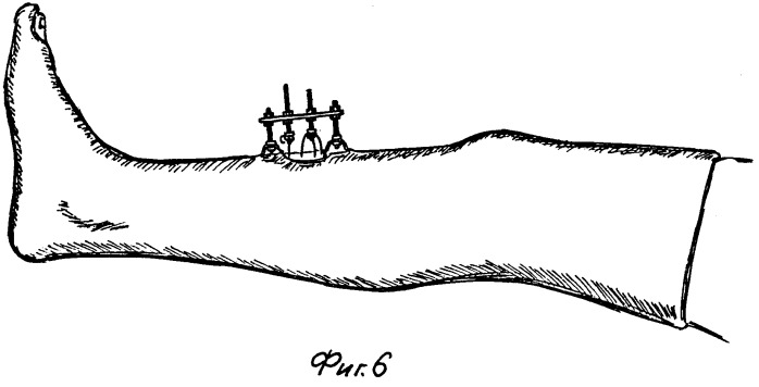 Устройство для лечения косых и оскольчатых переломов голени (патент 2264187)