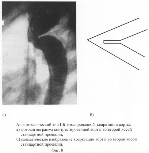 Способ диагностики изолированной коарктации аорты и способ выбора тактики ее лечения (патент 2244510)