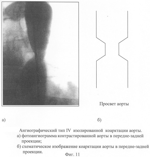 Способ диагностики изолированной коарктации аорты и способ выбора тактики ее лечения (патент 2244510)