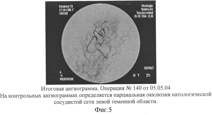 Способ эмболизации артериовенозных мальформаций головного мозга в условиях общей анестезии и управляемой гипотонии (патент 2315634)