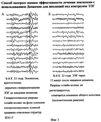 Способ экспресс-оценки эффективности лечения эпилепсии с использованием депакина для инъекций под контролем ээг (патент 2314803)