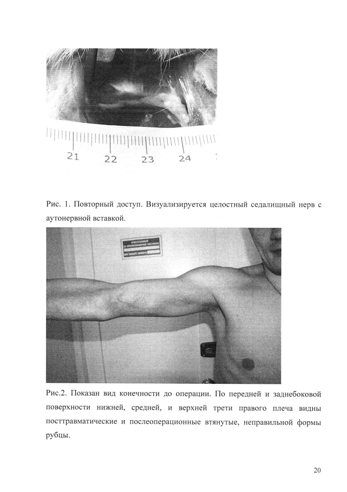 Способ индукции регенерации периферического нерва (патент 2639175)