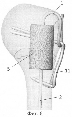 Способ хирургического лечения оскольчатого перелома проксимального отдела плечевой кости, скоба и имплантат для его осуществления (патент 2405487)