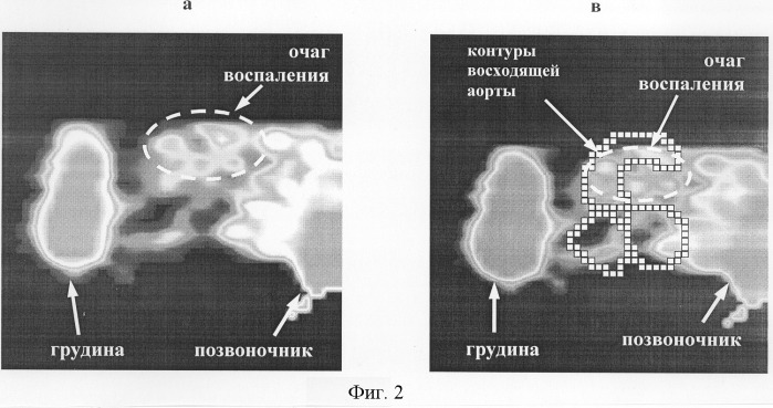 Способ топической диагностики воспалительных заболеваний сердца (патент 2244515)