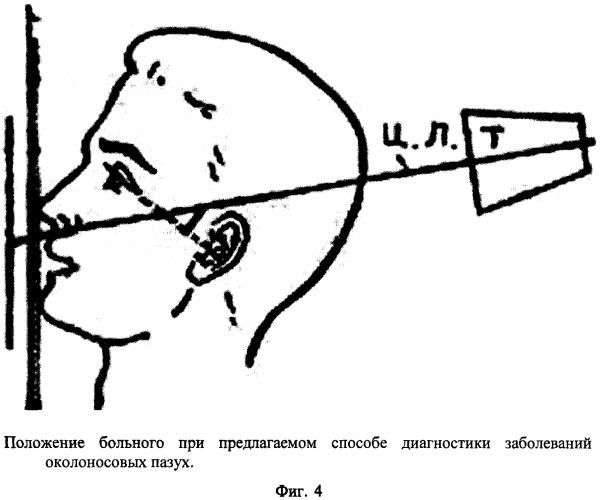 Способ рентгенографии околоносовых пазух (патент 2309676)