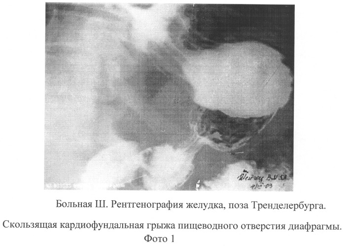 Способ пластики грыжи пищеводного отверстия диафрагмы (патент 2261663)