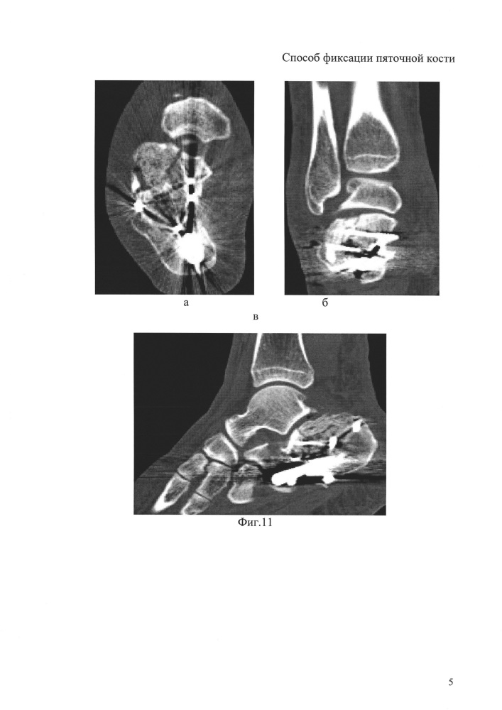 Способ фиксации пяточной кости (патент 2613727)