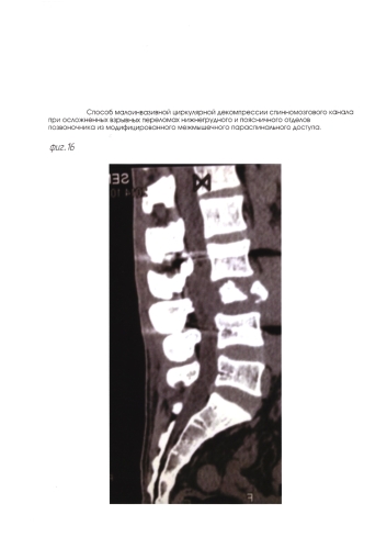 Способ малоинвазивной циркулярной декомпрессии спинномозгового канала при осложненных взрывных переломах нижнегрудного и поясничного отделов позвоночника из модифицированного межмышечного параспинального доступа (патент 2592779)