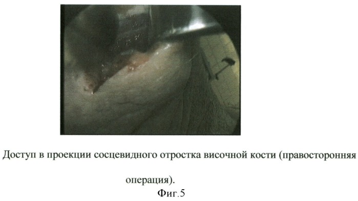 Способ эндовидеохирургического доступа к доле щитовидной железы (патент 2500355)