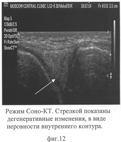 Способ комплексной ультразвуковой диагностики повреждения внутреннего мениска коленного сустава в области тела и переднего рога (патент 2305493)