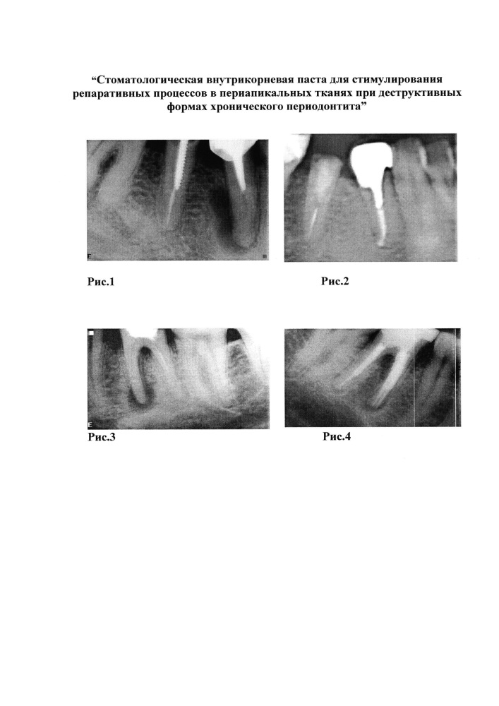 Стоматологическая внутрикорневая паста для стимулирования репаративных процессов в периапикальных тканях при деструктивных формах хронического периодонтита (патент 2618424)