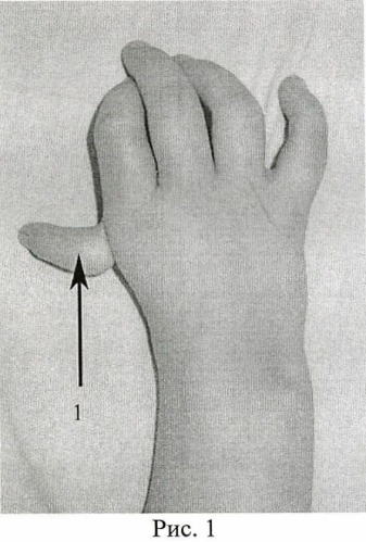 Способ реконструкции первого пальца кисти у детей с врожденной гипоплазией первого пальца кисти (патент 2471444)
