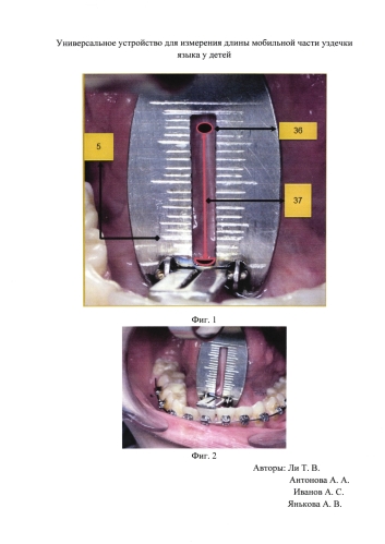 Универсальное устройство для измерения длины части уздечки языка у детей (патент 2584138)