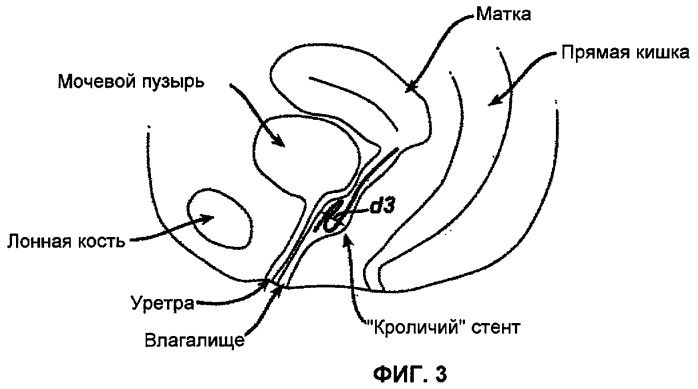 Способ лечения недержания мочи (патент 2467726)