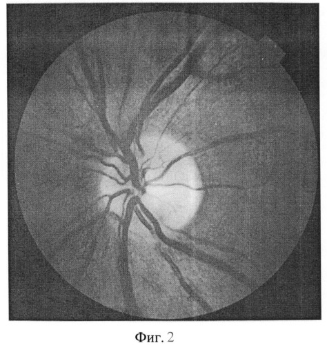 Способ диагностики патологии зрительного нерва (патент 2496404)