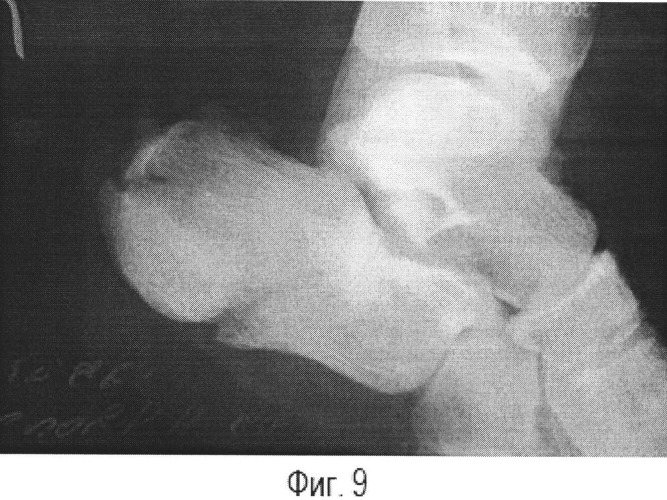Способ оперативного лечения закрытых оскольчатых языкообразных переломов пяточной кости (патент 2520800)
