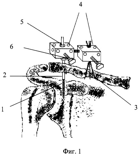 Способ чрескостного остеосинтеза переломовывихов акромиального конца ключицы (патент 2299701)