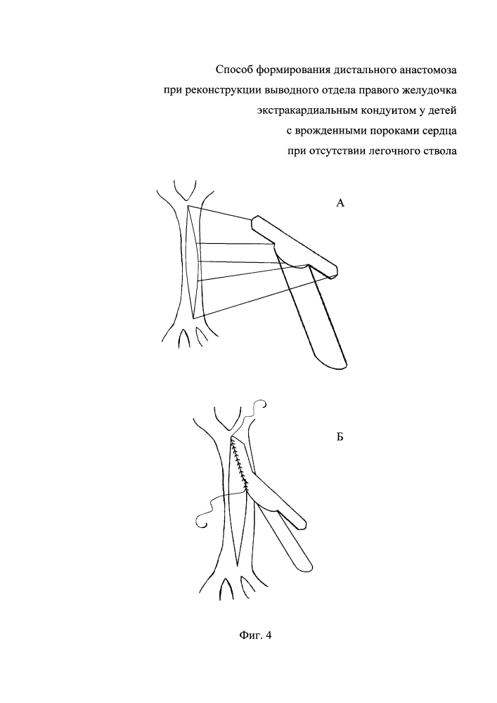 Способ формирования дистального анастомоза при реконструкции выводного отдела правого желудочка экстракардиальным кондуитом у детей с врожденными пороками сердца при отсутствии легочного ствола (патент 2644937)