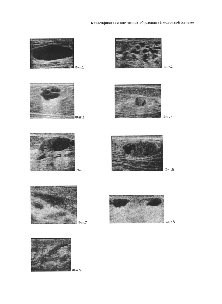 Классификация кистозных образований молочной железы (патент 2639804)