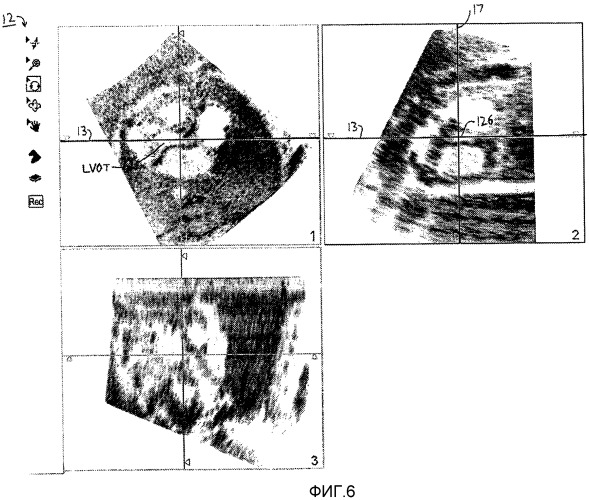 Создание стандартизованных протоколов для анализа данных трехмерной эхограммы (патент 2514112)