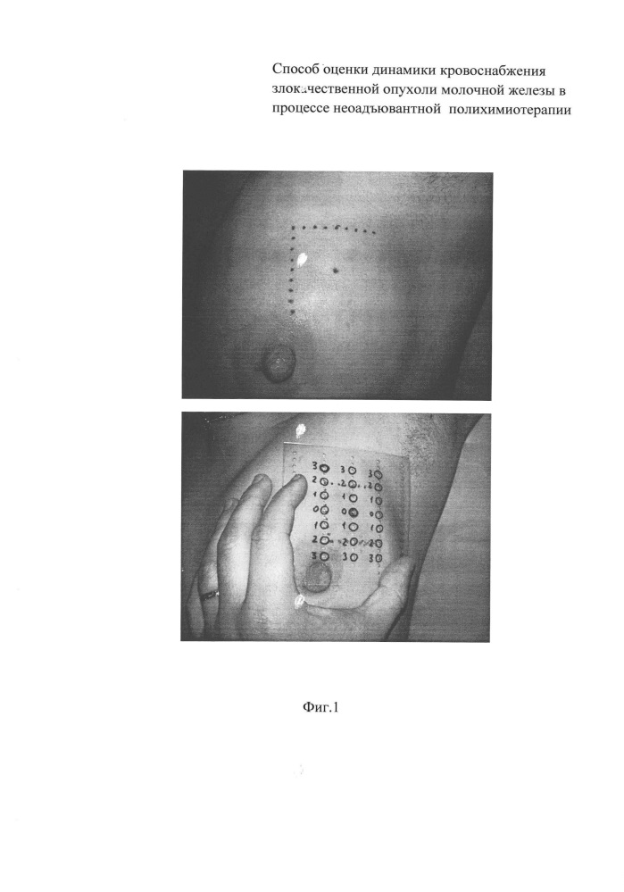 Способ оценки эффективности неоадъювантной полихимиотерапии злокачественной опухоли молочной железы (патент 2641158)