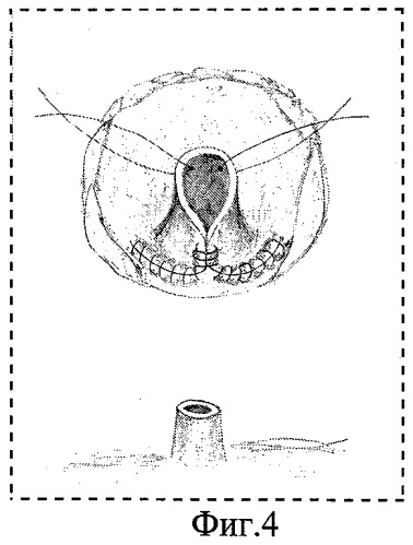 Способ формирования шейки мочевого пузыря после простатэктомии (патент 2462201)