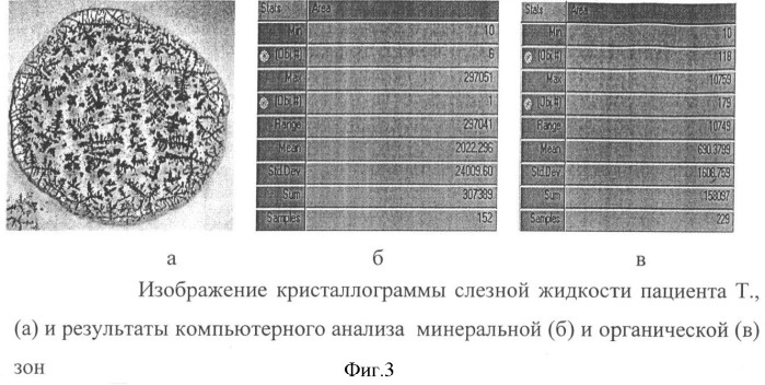 Способ дифференциальной диагностики инфекционно-воспалительных осложнений при травме глаза (патент 2356053)