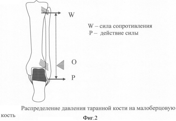 Модель системы стабилизации таранной кости при переломовывихах голеностопного сустава (патент 2340010)